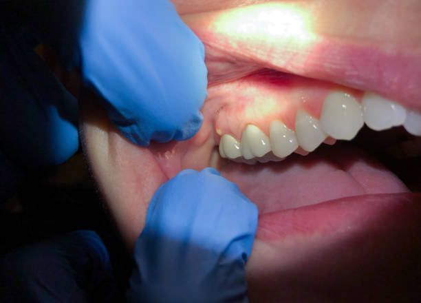 Best Emergency Dental Care for Broken or Chipped Teeth in Truth Or Consequences, NM